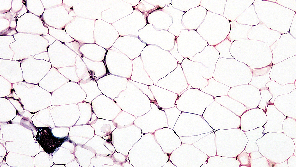 Connective Tissue: Adipose. Adipose tissue, or fat, is an anatomical term for loose connective tissue composed of adipocytes