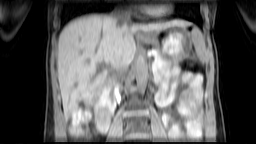 Coronal view of a 4D-MRI scan showing respiratory motion in abdomen