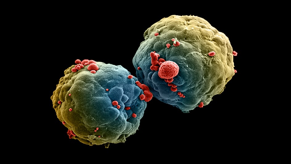 False-coloured scanning electron micrograph (SEM) of a 3-day old breast tumour spheroid