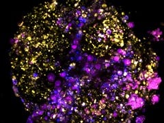 A patient organoid derived from bowel cancer, with cells within the tumour microenvironment fluorescently tagged.