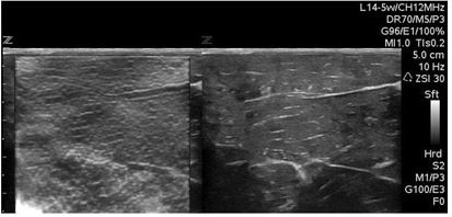 A freehand strain elastography image of breast cancer, that measures the stiffness of tumours compared with healthy tissue