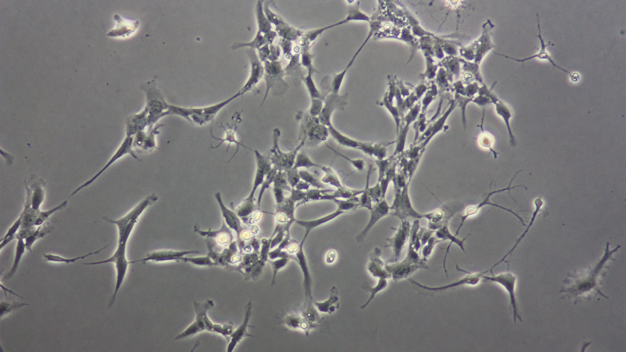 Glioblastoma cells under a microscope