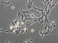 Glioblastoma cells under a microscope.
