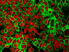 Human colon cancer cells with the cell nuclei stained red and the protein E-cadherin stained green.
