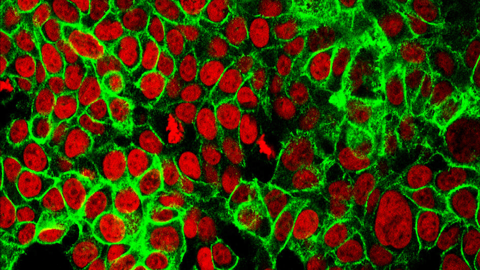 Human colon cancer cells with the cell nuclei stained red and the protein E-cadherin stained green.