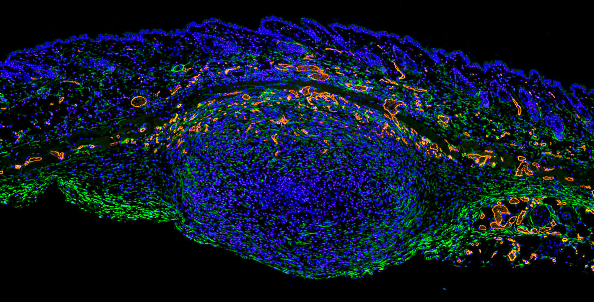 Keeping an eye on cancer – implanted breast cancer cells pushing upwards through layers of skin by Sarah Ash, PhD Student – Molecular Cell Biology Team, Division of Breast Cancer Research