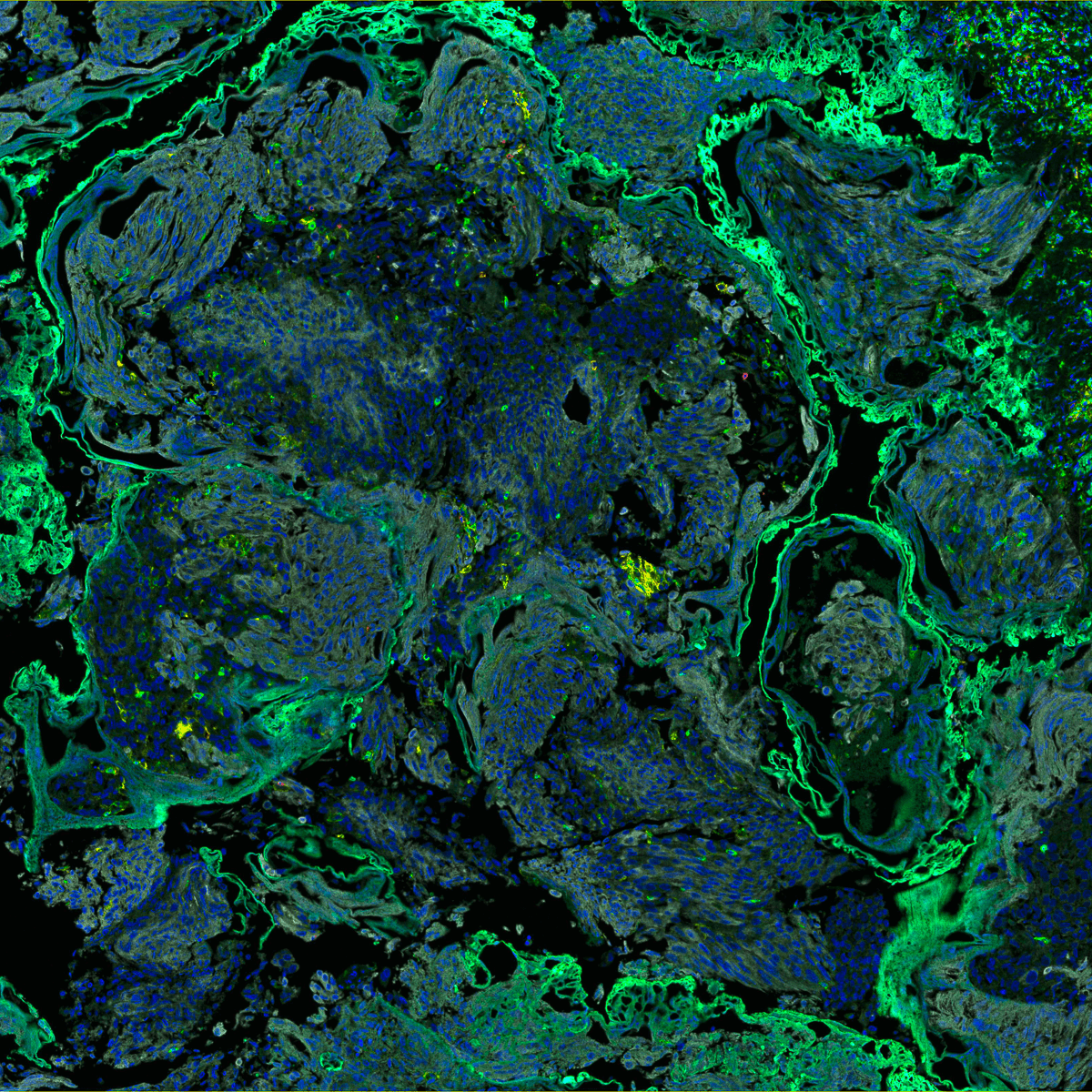 ICR Science and Medical Imaging Competition 2022 Shortlist Image 1: Islands - Immunofluorescence staining of bladder tumour tissue by PhD student Rose Foster