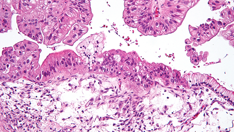 Intermediate magnification micrograph of a low malignant potential (LMP) mucinous ovarian tumour