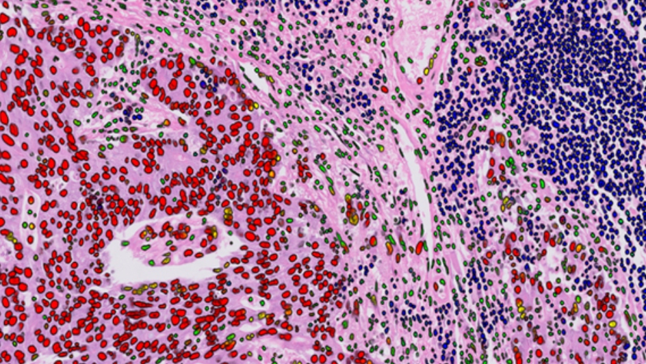 A cancer sample pathology slide with computerised data points