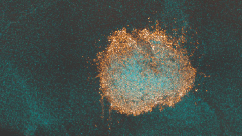 Human DIPG cells (orange) grown on a mouse brain 'slice' (light blue), treated with the drug combination, trametinib and dasatinib and showing cells dying in the middle.