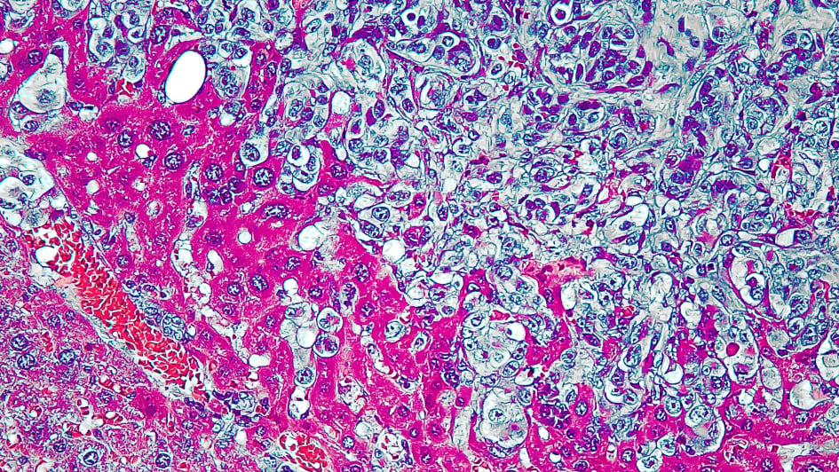 Liver Metastasis in Kaposi Sarcoma Mouse Model by Anthony B. Eason