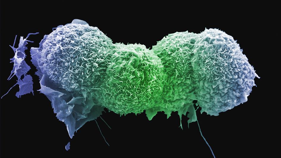 Lung cancer cells. Anne Weston, Francis Crick Institute
