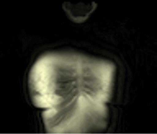 Movie showing a fly through the chest of a patient with non-small cell lung cancer