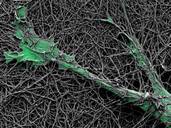 Caption for: Skin cancer cells harness nerve cell gene to drill through and invade new tissues