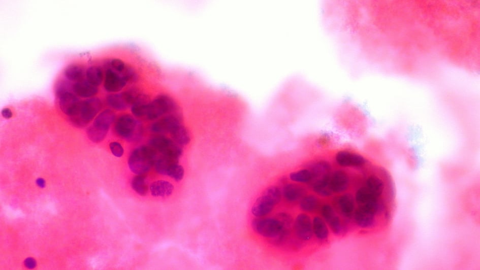 Metastatic breast cancer cells in pleural fluid
