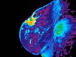 Imaging tumour stiffness could help enhance treatment for breast and pancreatic cancer