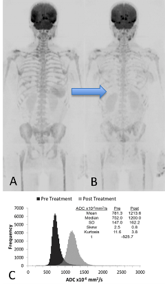 Whole body diffusion weighted magnetic resonance imaging of a skeleton