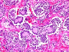 Neuroblastoma in Adrenal Gland