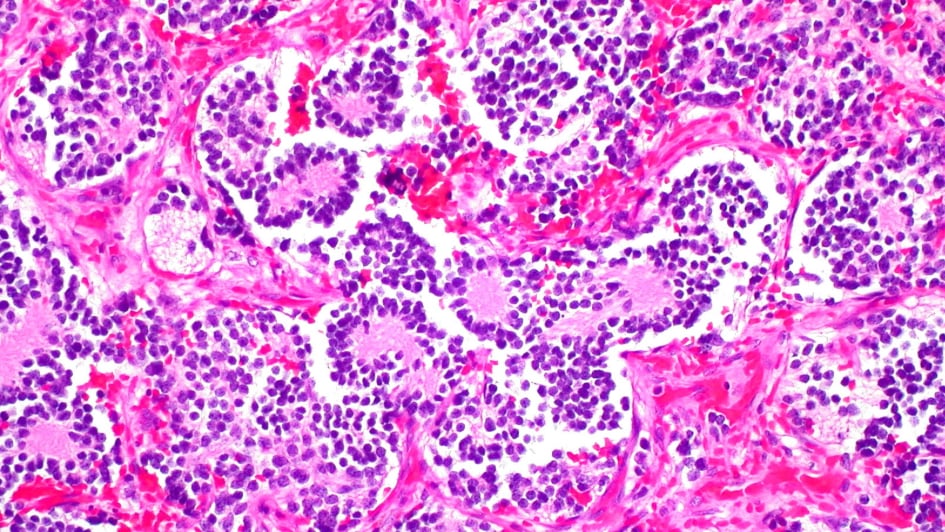 Neuroblastoma of the Adrenal Gland 945x532