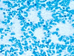 neuroblastomas rosettes