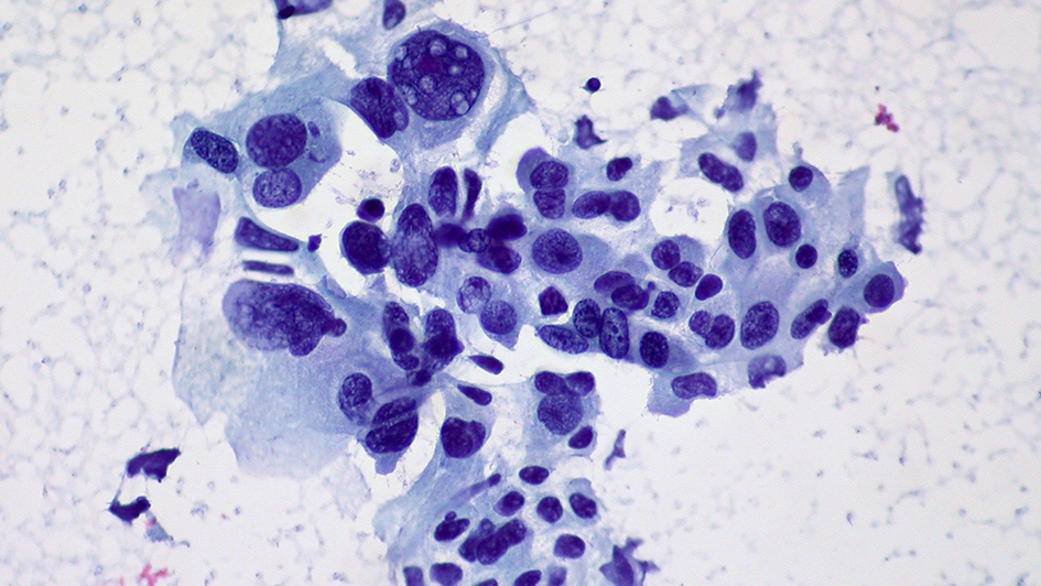 Non-small cell lung cancer (photo Dr Ed Uthman-Yale Rosen-Flickr CC BY-SA 2.0)