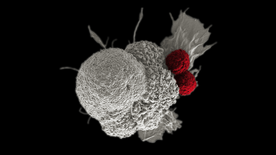Oral squamous cancer cell (white) being attacked by two cytotoxic T cells (red)