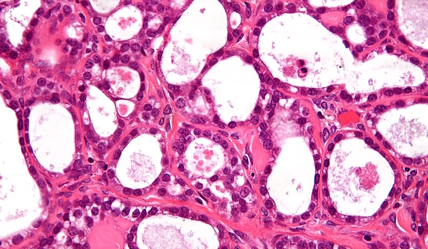 A high magnification image of ovarian clear cell carcinoma (photo: Nephron)