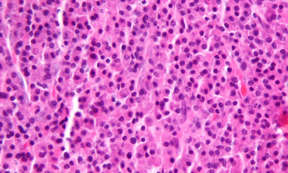 Micrograph showing abundant (malignant) plasma cells