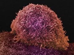 Prostate cancer cell 547x410