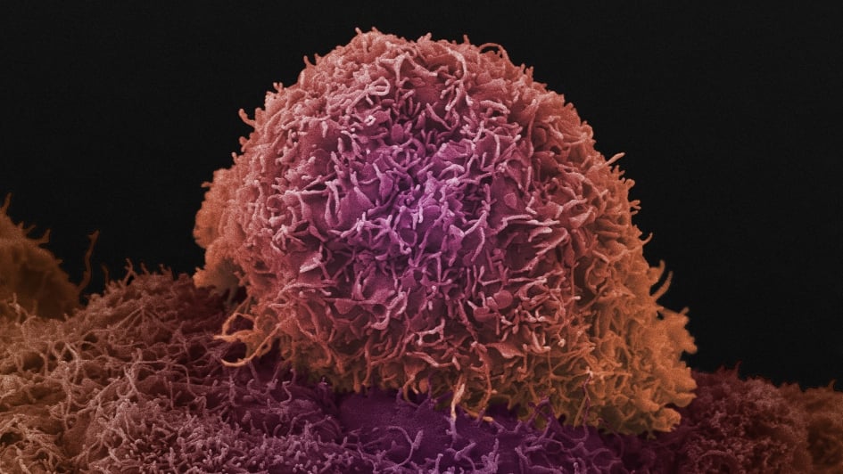 Prostate cancer cell 945x532