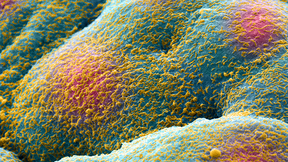 Prostate cancer cell spheroid