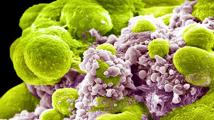 Prostate cancer cells treated with nano sized drug carriers