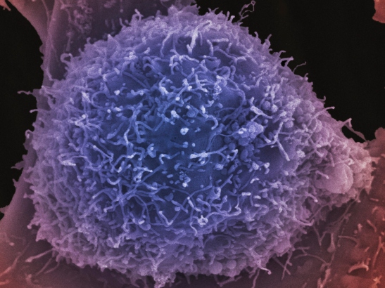 Caption for:  ‘Search and destroy’ treatment improves quality of life for patients with advanced prostate cancer