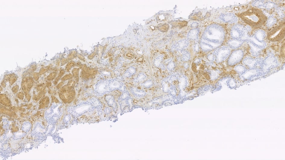 Prostate tumour biopsy sample from a patient showing staining patterns of the PTEN protein - areas that show normal protein are stained brown and areas that show loss of protein are unstained