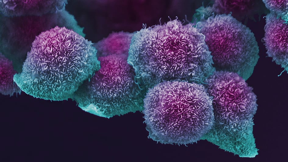False colour scanning electron micrograph of a cluster of pancreatic cancer cells grown in culture.