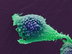 Scanning electron micrograph of a single prostate cancer cell