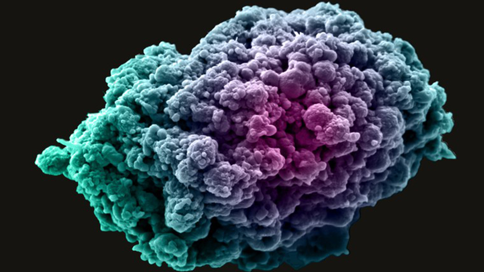 SEM of a 3-day old breast tumour spheroid