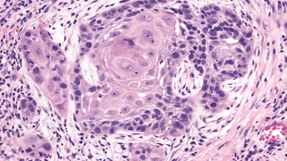 squamous-cell-carcinoma-histopathology-16-927x617 (1)