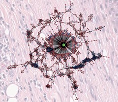A topological tumour graph, showing cancer cell nodes within a tissue sample of melanoma