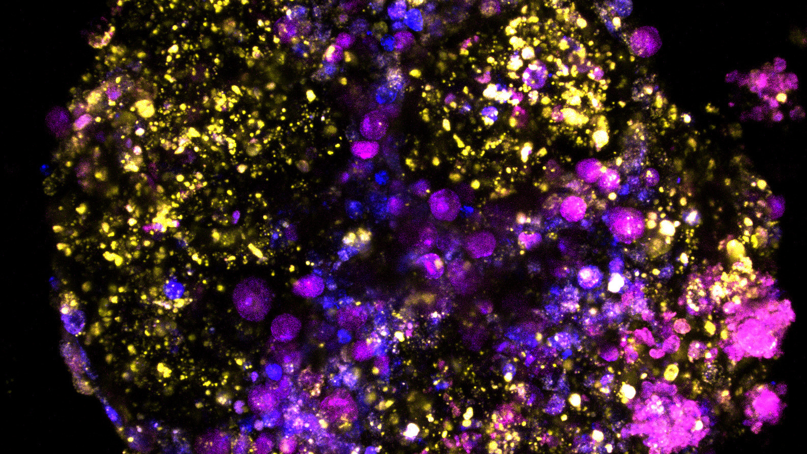 An organoid derived from bowel cancer. Fluorescent tags have been added to different cells within the tumour microenvironment.