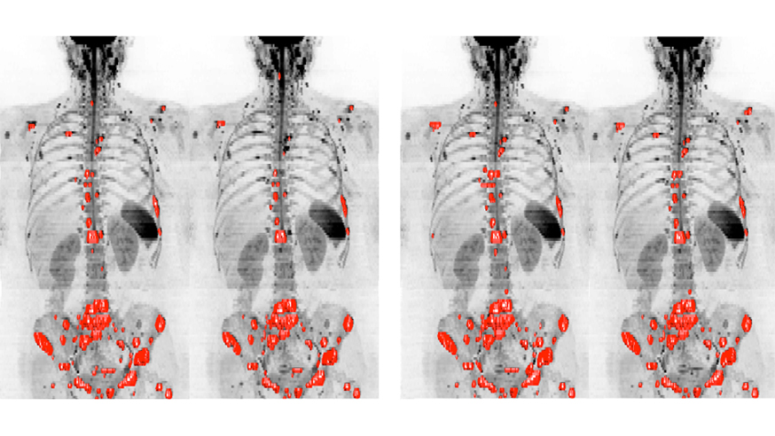 Whole body MRI scans of a breast cancer patient, assessed by two observers, to measure tumours in the patient’s bones.  The software could help clinicians reliably assess how bone disease changes over time (image: Blackledge et al 2016)