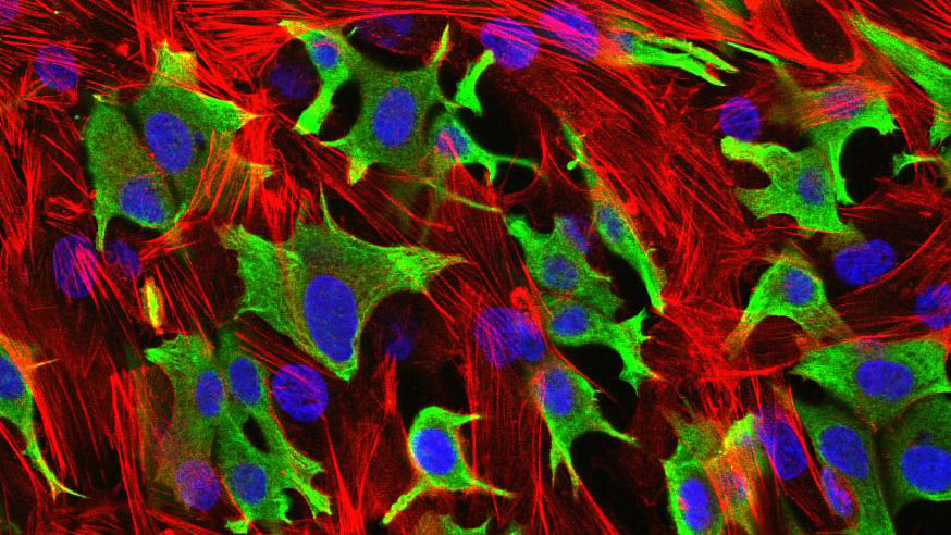 breast cancer cells invading through a layer of fibroblasts