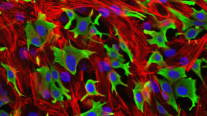 Breast cancer cells invading through a layer of fibroblasts. 