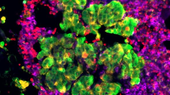 Prostate cancer cell. Photo: Mateus Crespo/Professor Johann de Bono, the ICR