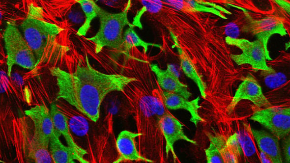 Breast cancer cells (green) invading through a layer of fibroblasts (red). (Luke Henry / the ICR, 2009)